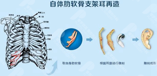 自体肋软骨做耳再造示意图