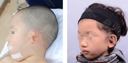 韩国普罗菲耳耳畸形矫正前后对比图