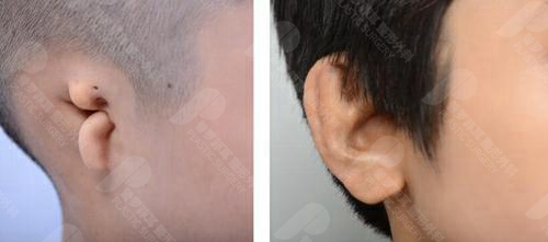 先天性小耳畸形能早点做耳再造手术吗？需要多少钱？