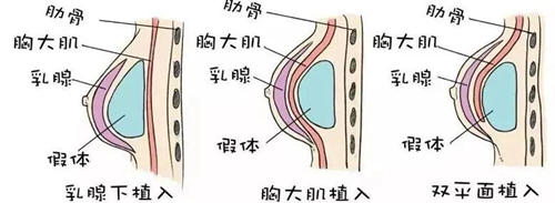 假体放置的三种位置分析