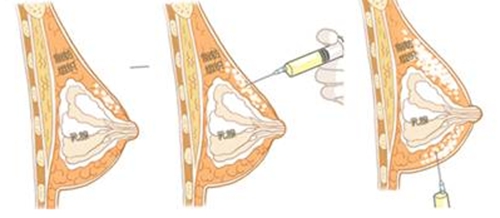 液态水分子丰胸是什么原理？会有什么后遗症吗？