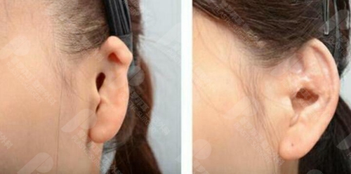 畸形耳朵治疗最佳时间是什么时候？使用人工支架几岁能做？