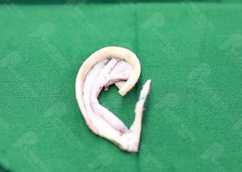 韩国普罗菲耳做耳畸形矫正使用的人工支架