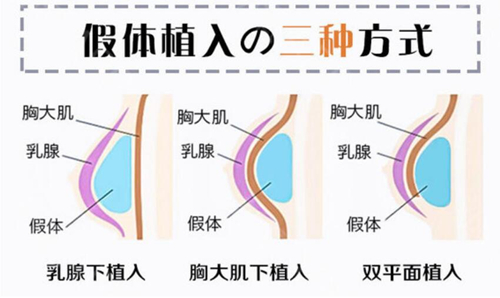 出彩医美十分钟隆胸是真的还是假的？