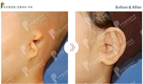 普罗菲耳整形外科医院耳再造对比