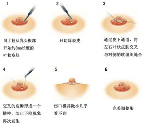 乳头内陷矫正费用