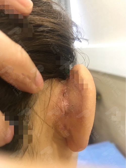 韩国普罗菲耳精灵耳手术切口展示