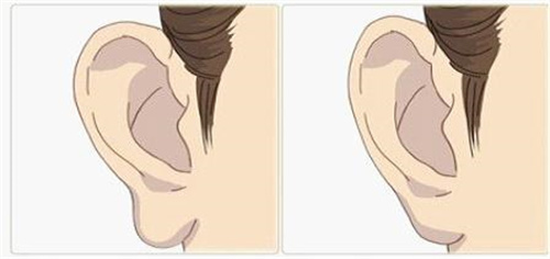 耳垂整形有没有危险？