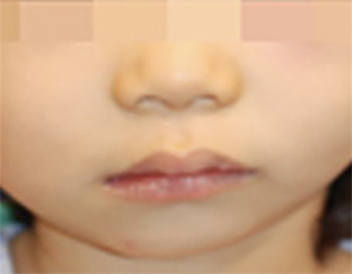 面部严重不对称导致的无耳症照片